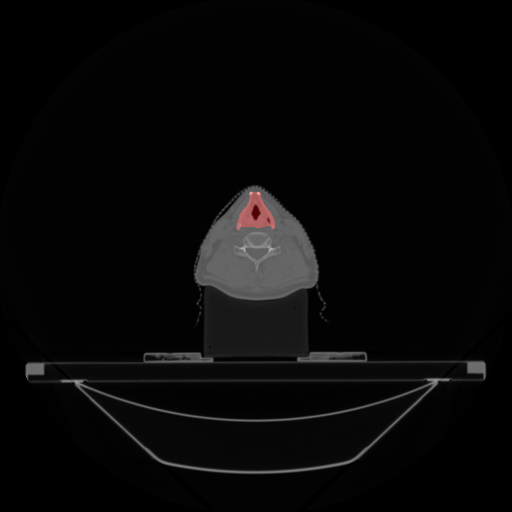 CT scan of neck region